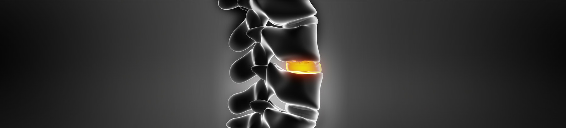 Miami Spine Specialists | Spine Acupuncture Treatment Miami