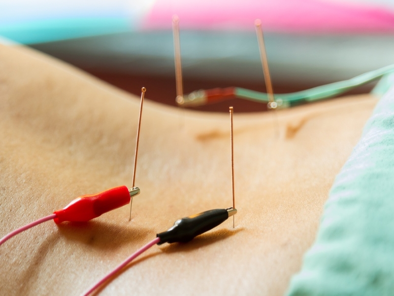 Acupuncture In Hollywood Fl